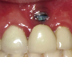 North West Dental Implant Repairs