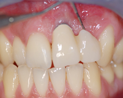 Dental Implant Repairs North West 