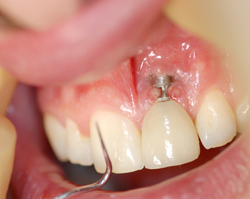 North West Dental Implant Repairs